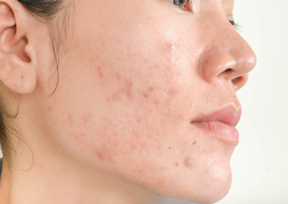 Acne e pele sensível: como tratar sem irritar