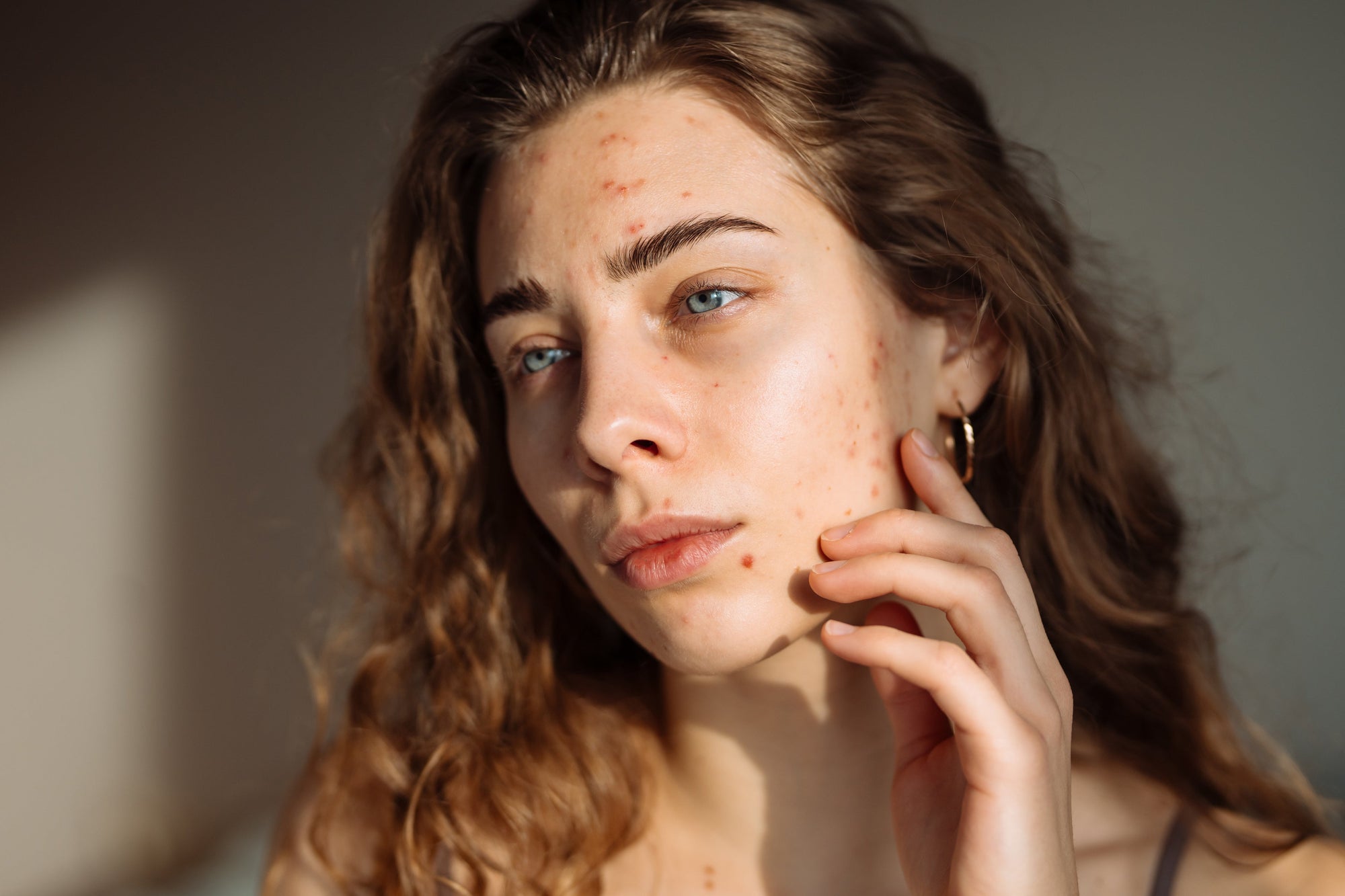 Acne da Mulher Adulta: o que é, sintomas e como tratar de verdade